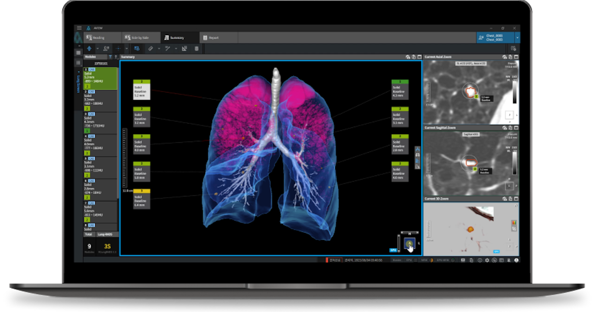 
  Interface of Coreline Soft's lung cancer imaging AI software

