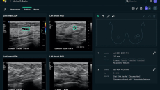 Breast scan analysis via See-Mode software