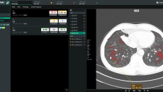 An interface of Coreline Soft's lung cancer screening analysis software