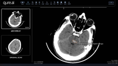 Interface of the Qure.ai qER software