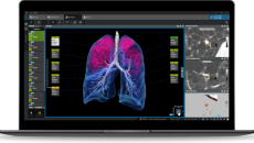 Interface of Coreline Soft's lung cancer imaging AI software