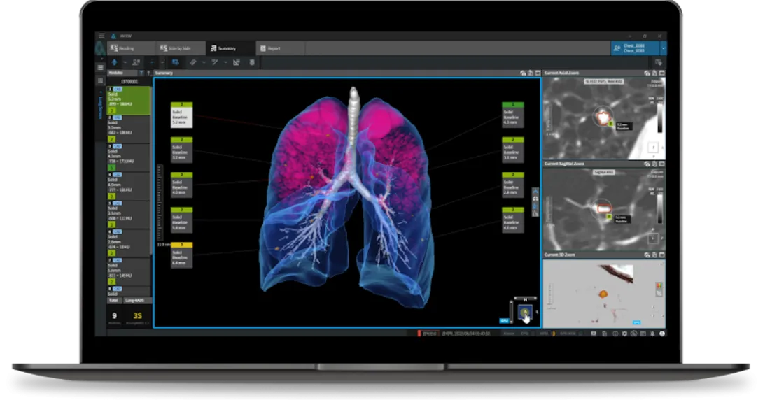 Interface of Coreline Soft's lung cancer imaging AI software
Interface of Coreline Soft's lung cancer imaging AI software