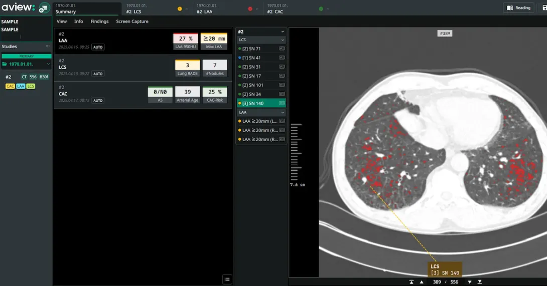 An interface of Coreline Soft's lung cancer screening analysis software