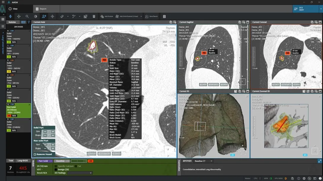 Coreline Soft's flagship product, AVIEW LCS, an AI-powered automatic pulmonary nodule analysis solution