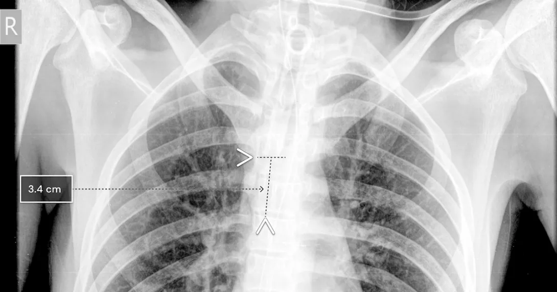 A chest x-ray showing Qure.ai's technology for breathing tube placement