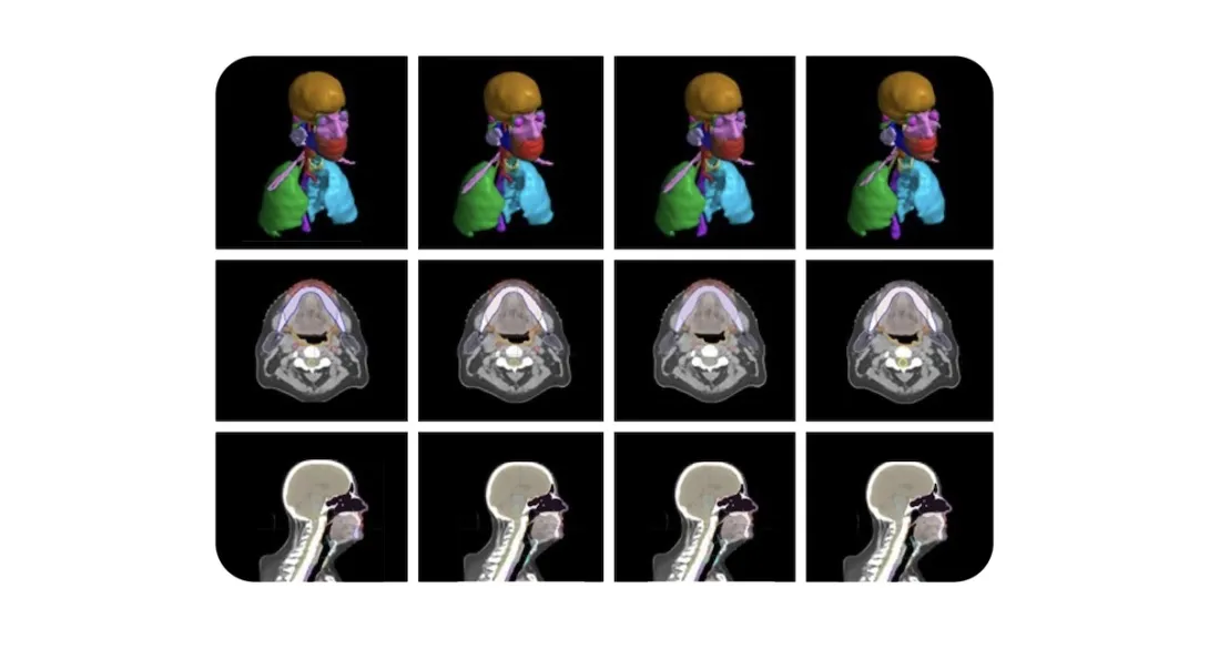 An image from the radiotherapy planning model developed by Google and the Mayo Clinic.
